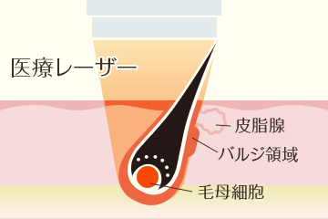 蓄熱式の医療レーザー脱毛の仕組み