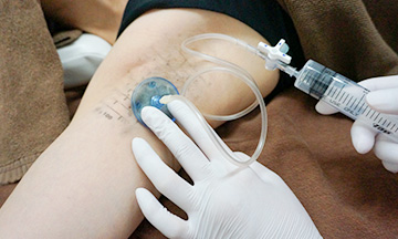 新宿マリア限定のインジェクションプレートによるミラドライの麻酔施術
